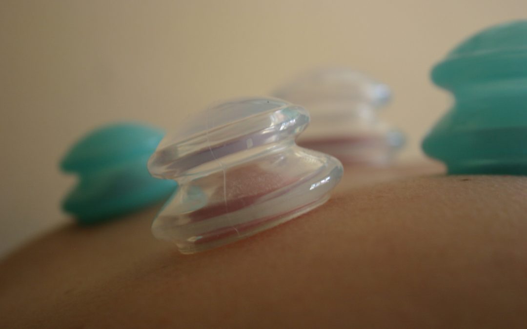 cupping for tight muscles, acupuncture for pain relief, acupuncture clinic in billings montana
