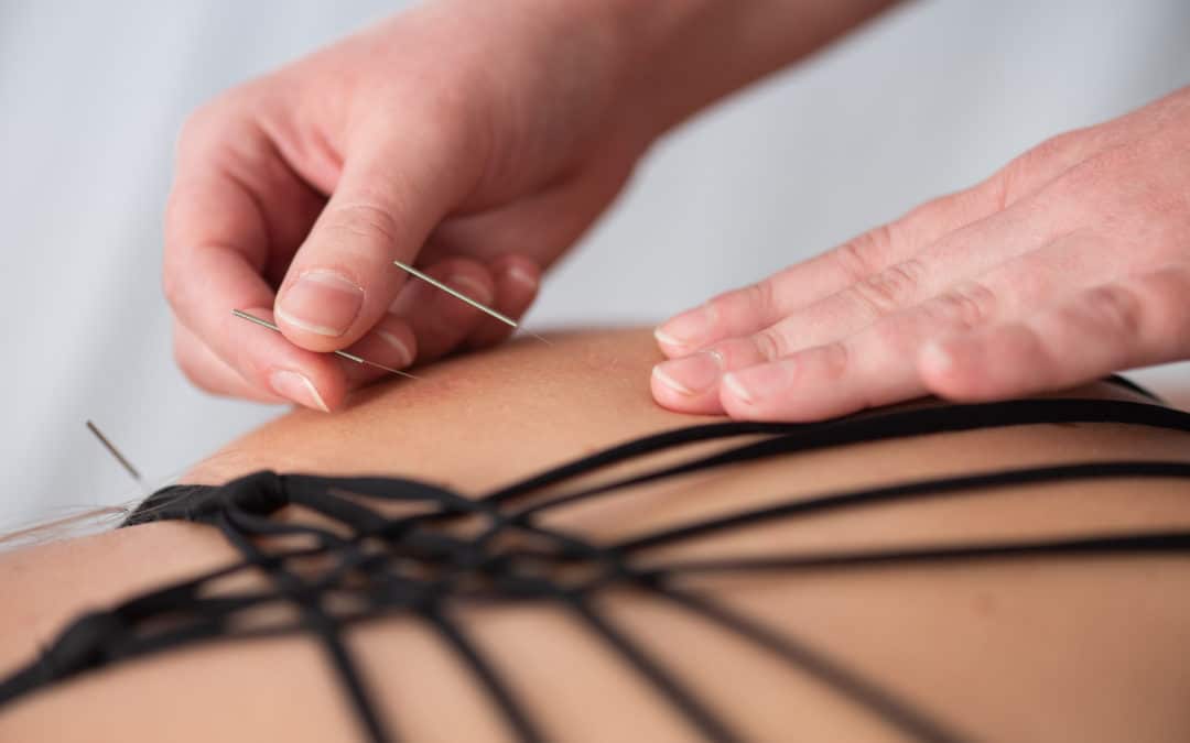 Acupuncture vs. Dry Needling – What’s The Difference?